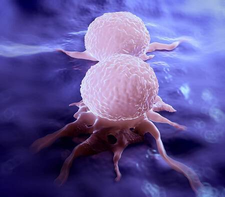 Μετάσταση καρκίνου: Ο καθοριστικός ρόλος της χοληστερίνης