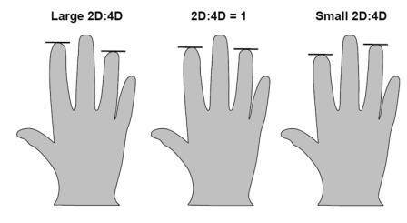 Το μήκος των δαχτύλων προβλέπει τον κίνδυνο οστεοαρθρίτιδας
