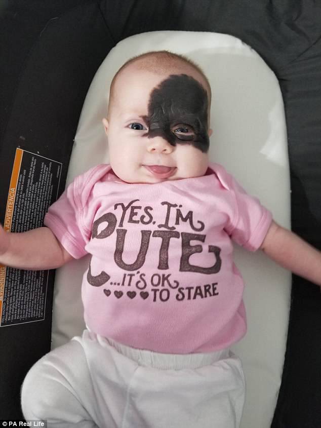 Four-month-old Natalie Jackson has been dubbed a 'little superhero' by her parents after being born with a Batman and Robin-style mask birthmark across her faceÂ 