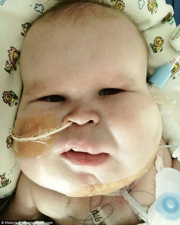 Gavin requires a breathing tube due to cysts developing around his windpipe in the wombÂ 