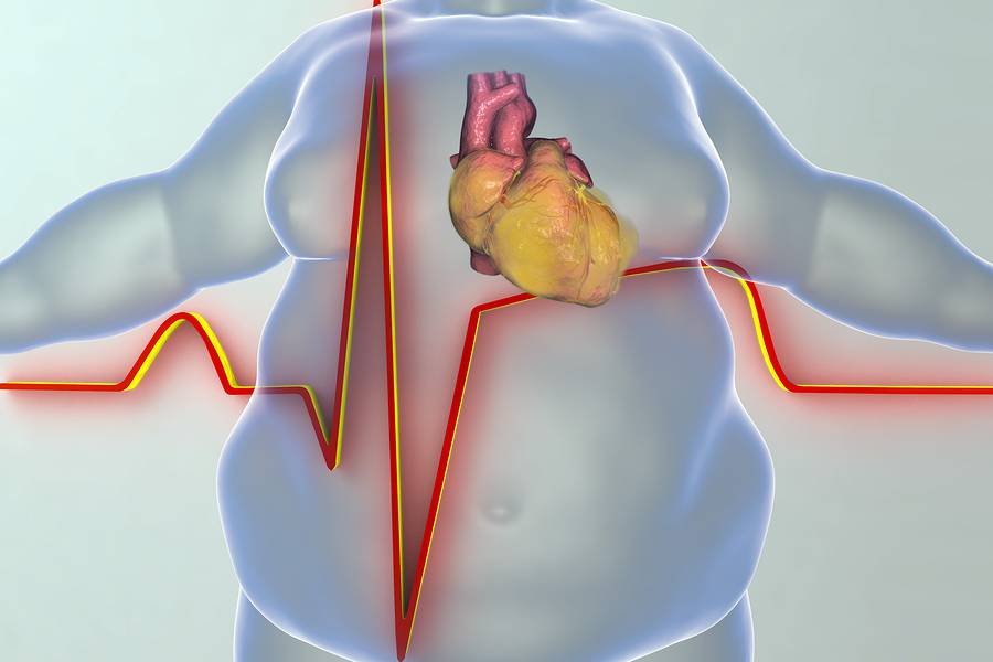 Κολπική μαρμαρυγή: Πόσο βάρος πρέπει να χάσετε για να απαλλαγείτε από την καρδιακή αρρυθμία