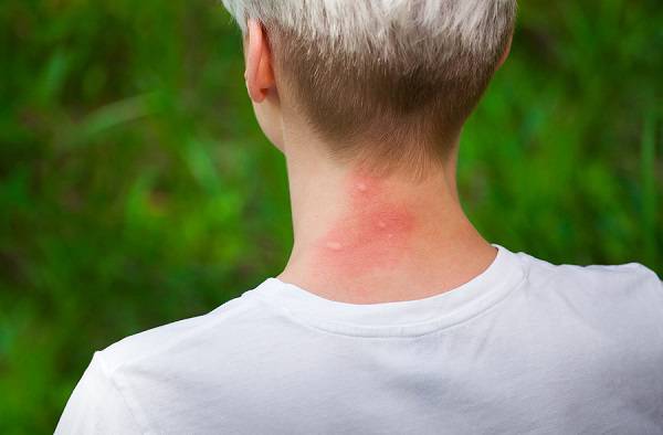 Τσίμπημα από κουνούπι: Τα συμπτώματα που δείχνουν σοβαρή αλλεργική αντίδραση