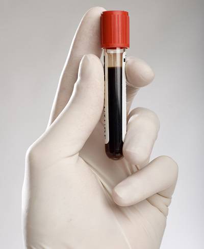 Αυξημένα λευκά αιμοσφαίρια: Δείτε τι σημαίνει ο δείκτης