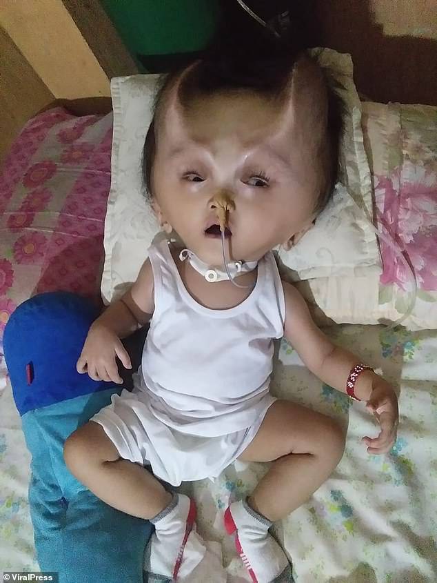 Clyne, from Pasig City in the Philippines, developed the horn-shaped ridges of bone on his head when surgeons operated to drain fluid and relieve pressure on his brain but parts of his skull caved in because they were weak