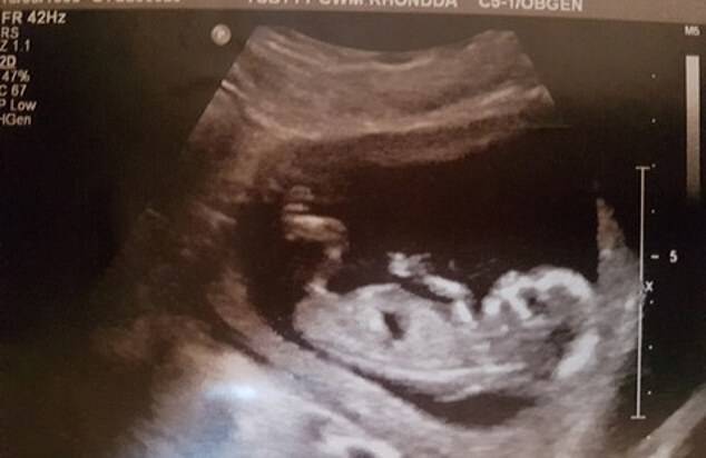At their 20 week scan a sonographer said she had spotted a large mass on the babyâs neck