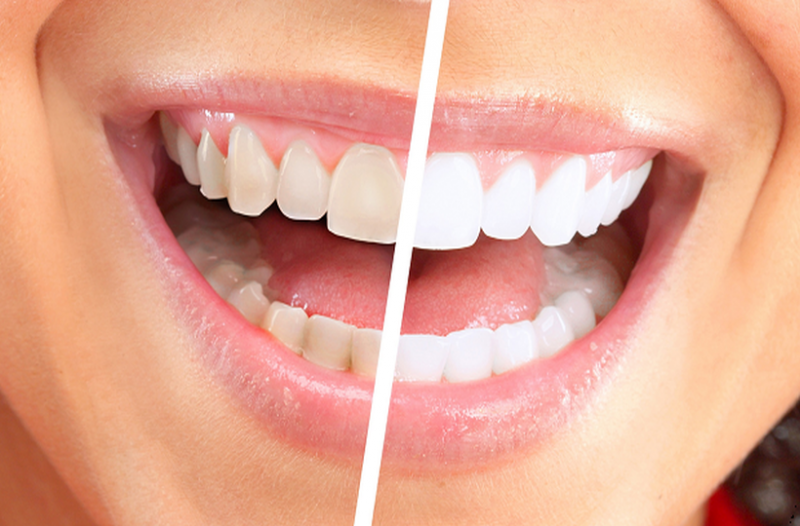Λεύκανση δοντιών: 8 Τρόποι που θα λατρέψετε!!! Το #6 κάνει θαύματα στα δόντια σας