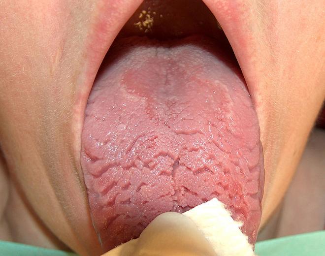 fissured tongue