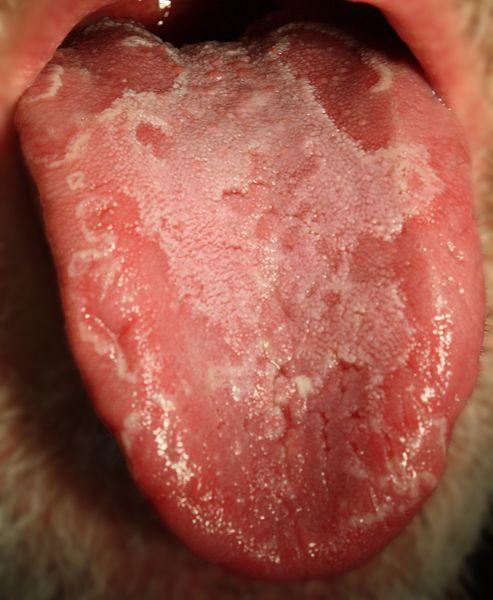 geographic tongue 1