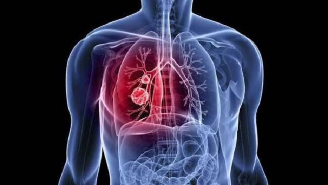 Τα απλά σημάδια που δείχνουν πιθανό καρκίνο του πνεύμονα
